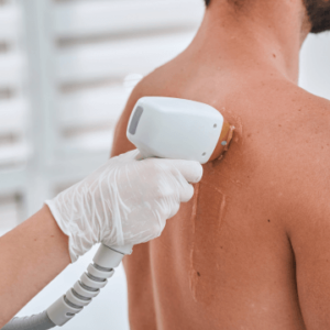 Laser Hair Removal Training